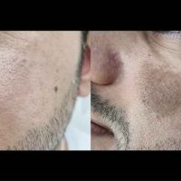 pigmentation-before-after-01